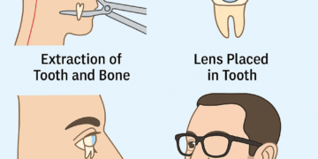 The Miracle of Tooth-in-Eye Surgery: How Science Restored Sight After 20 Years